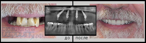 Имплантация одной челюсти all-on-4 в Израиле - Фото клинического случая №8